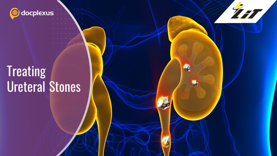 A Novel technique for Mobilizing and Removing Ureteral Stones in Awake Patients