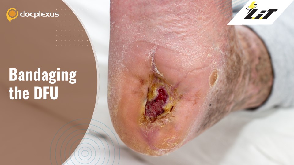 Bioprinted Bandages for Diabetic Foot Ulcer Treatment