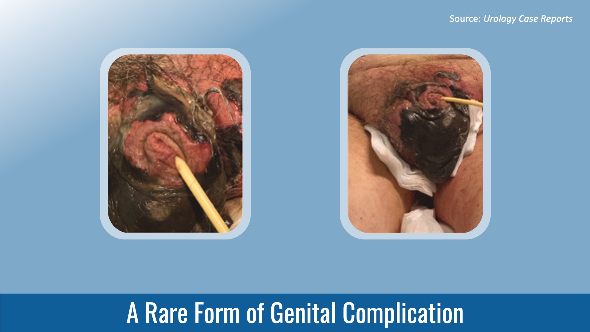 Identify This Rare Form of Genital Complication
