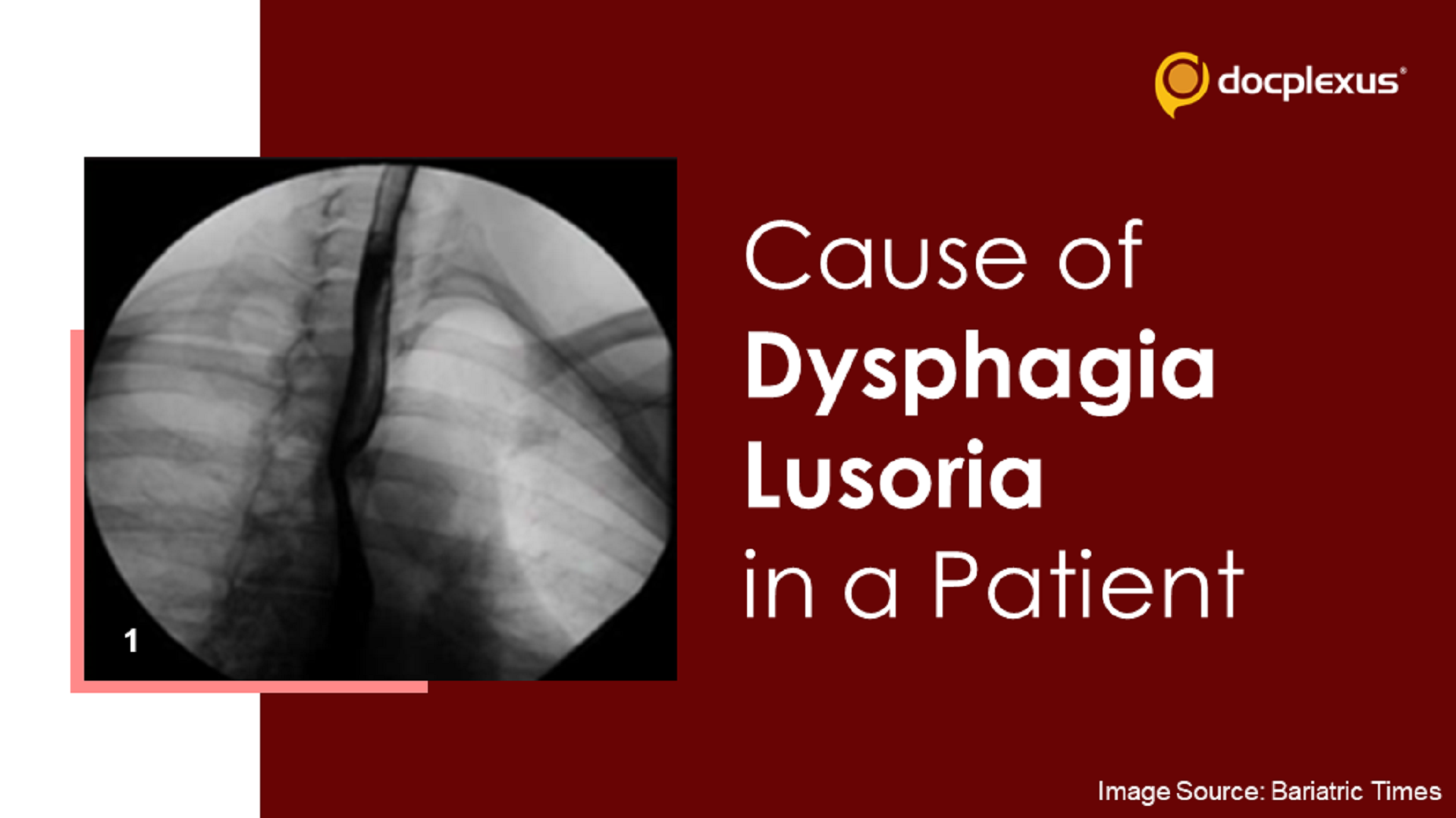 Dysphagia Lusoria Following Weight Loss Surgery