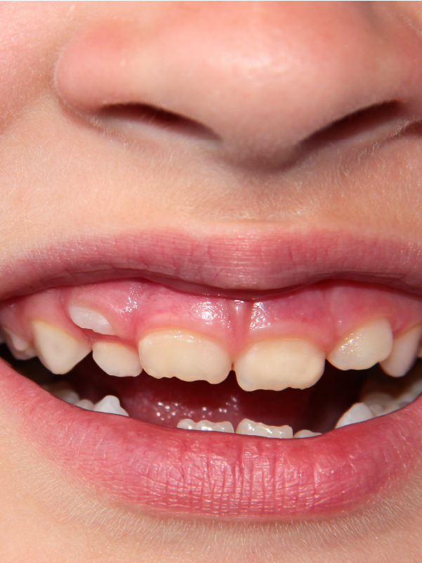 Vitamin D And Malocclusion