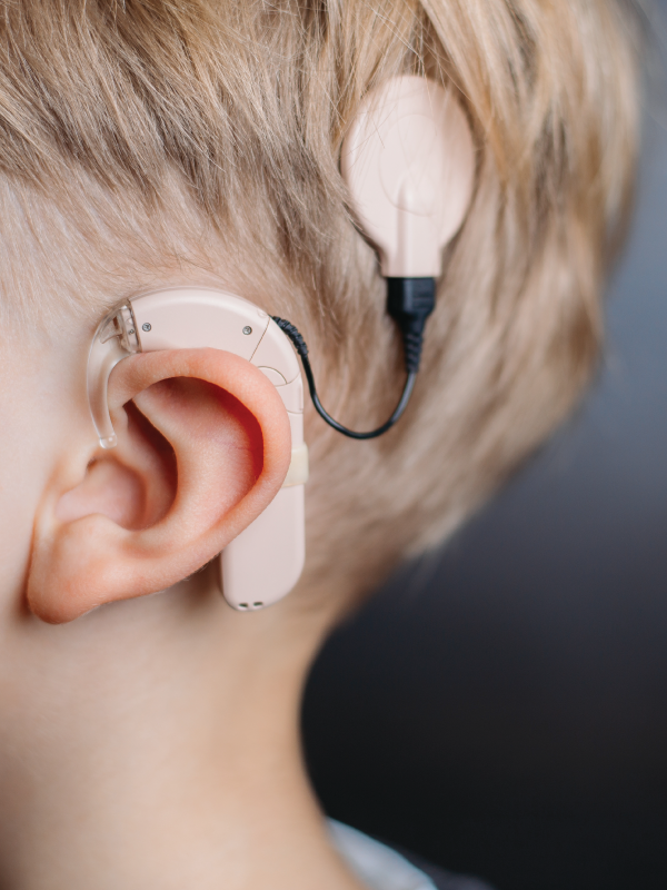 Cochlear Implants – Why, How, and When?
