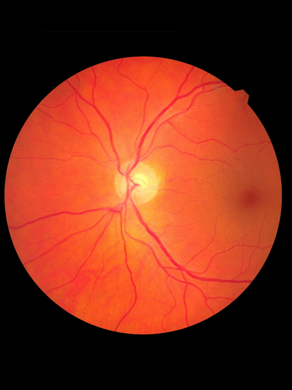 Anti-VEGF Treatment for Macular Degeneration