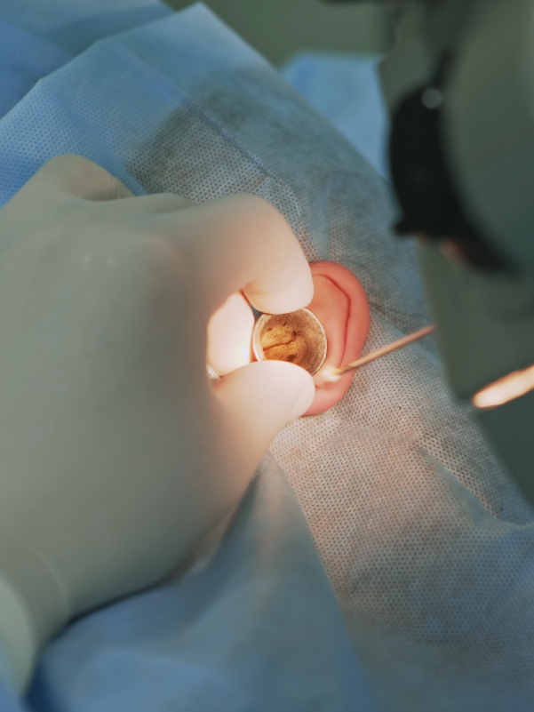 Stapedotomy Ear Surgery to Treat Otosclerosis