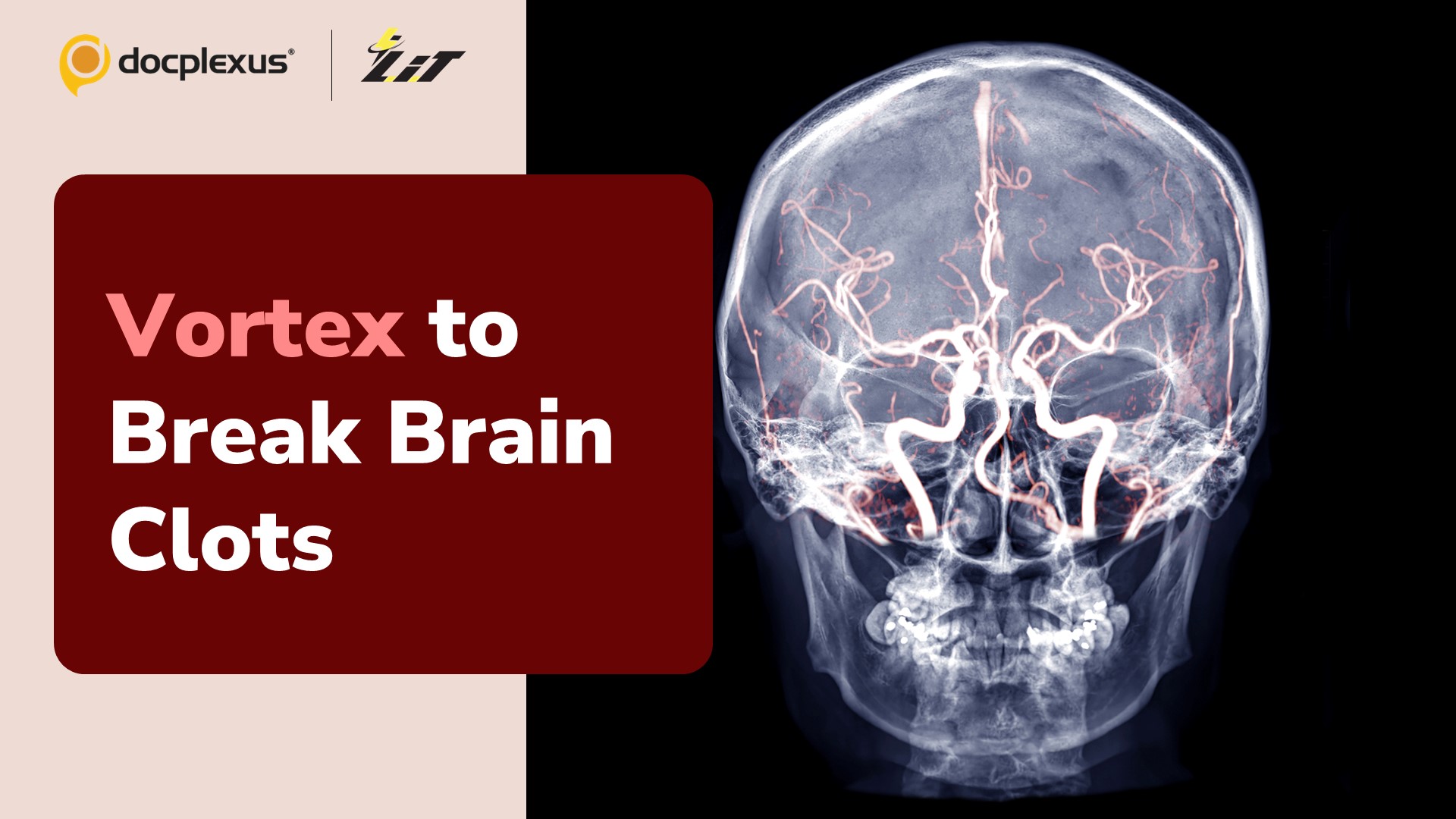 Novel Tool for Eliminating Brain Clots