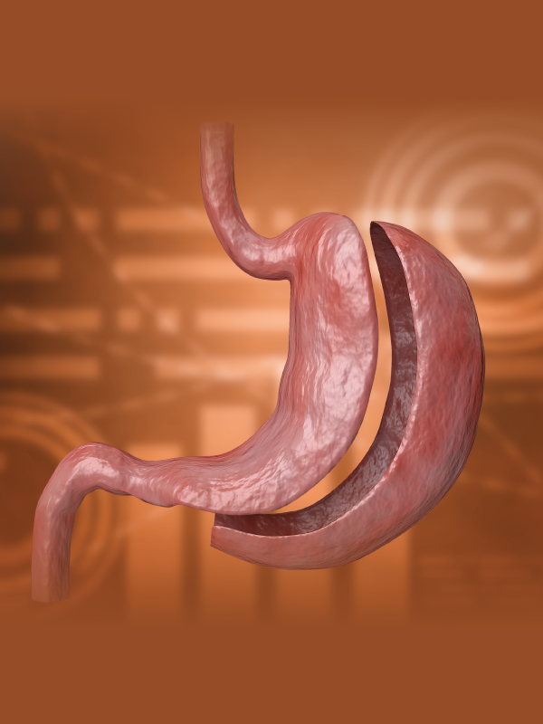 Myths and Facts of Bariatric Surgery
