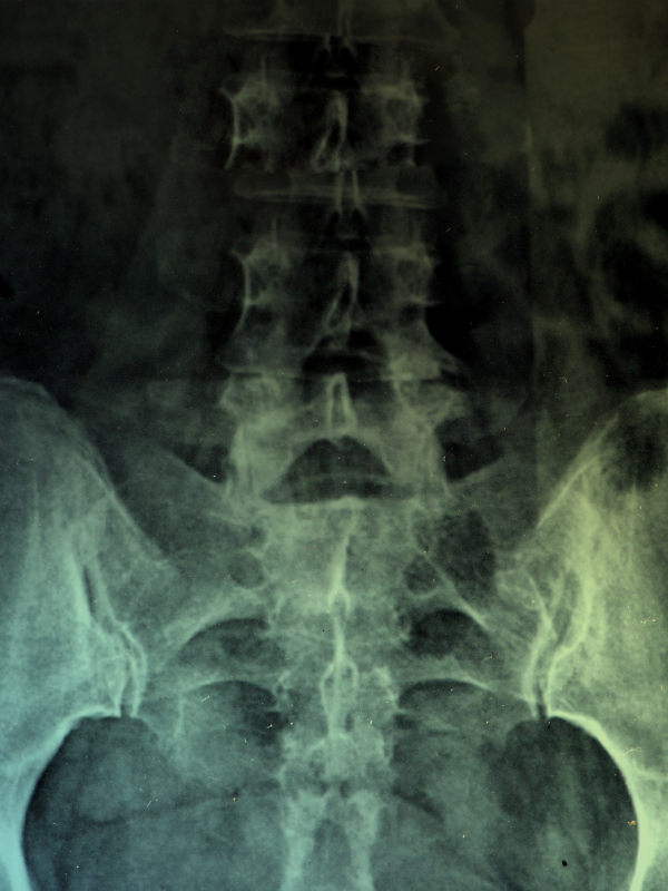 Women Who are at Risk for Hypoglycemia | Women with Osteoporosis