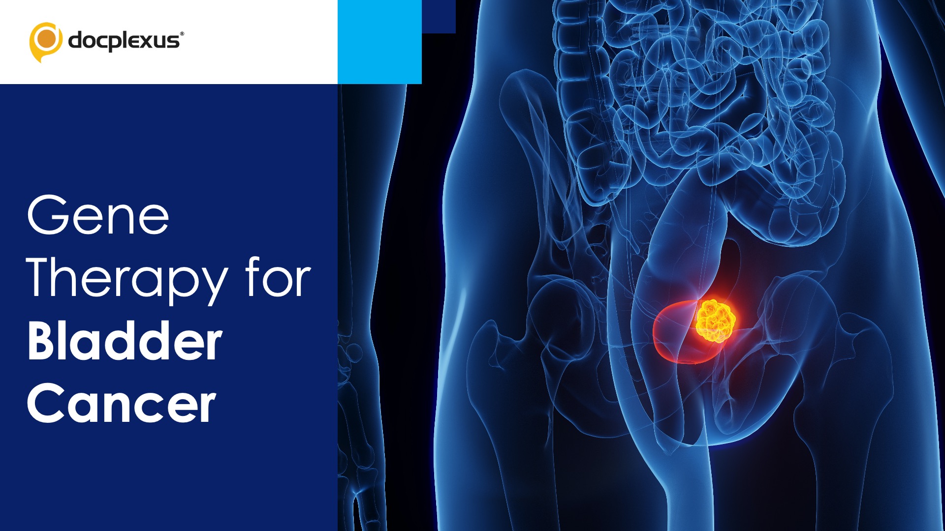 FDA Approves the First Gene Therapy for Bladder Cancer