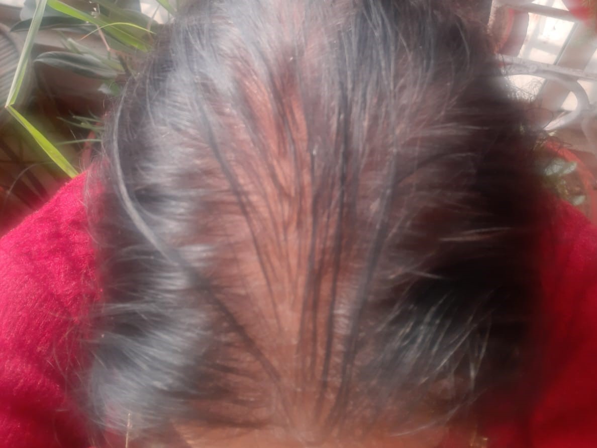 Hair Loss in a Postmenopausal Woman