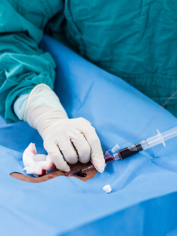 Do We Still Need Endophlebectomy for Deep Venous Stenting?