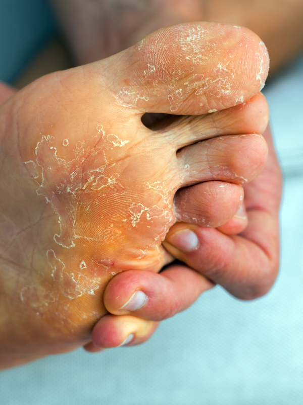 Current Problems in the Management of Superficial Fungal Infections