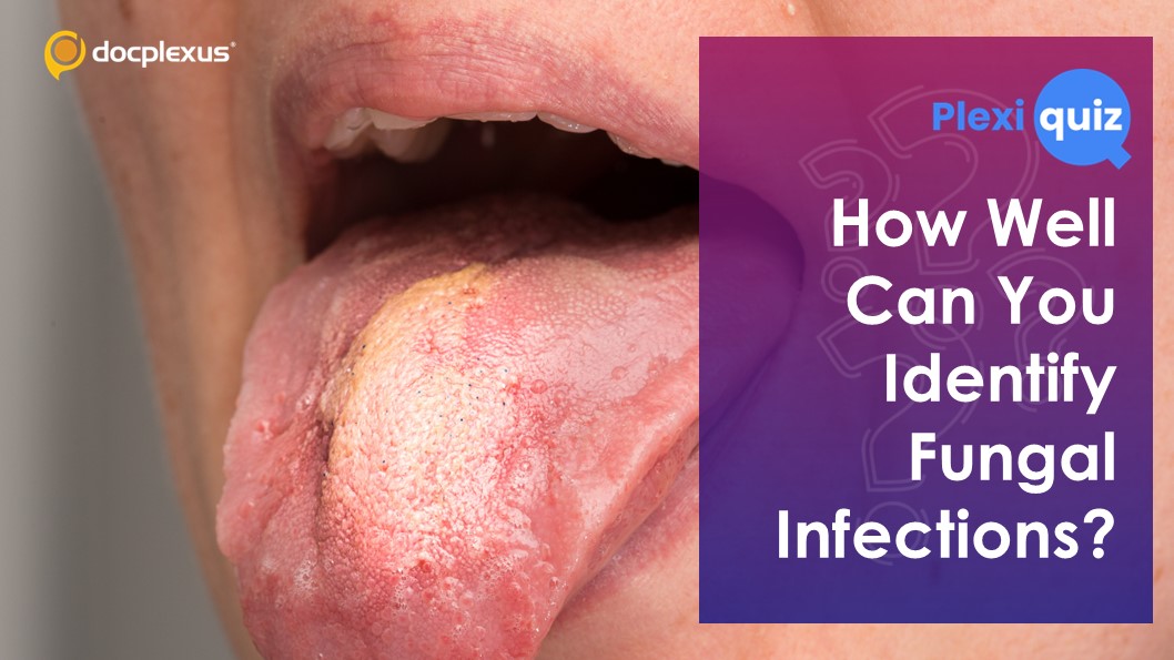 Oral Fungal Infections: Gauge Your Knowledge!