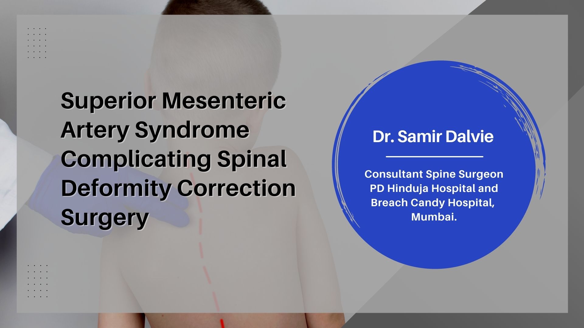 Superior Mesenteric Artery Syndrome Complicating Spinal Deformity Correction Surgery