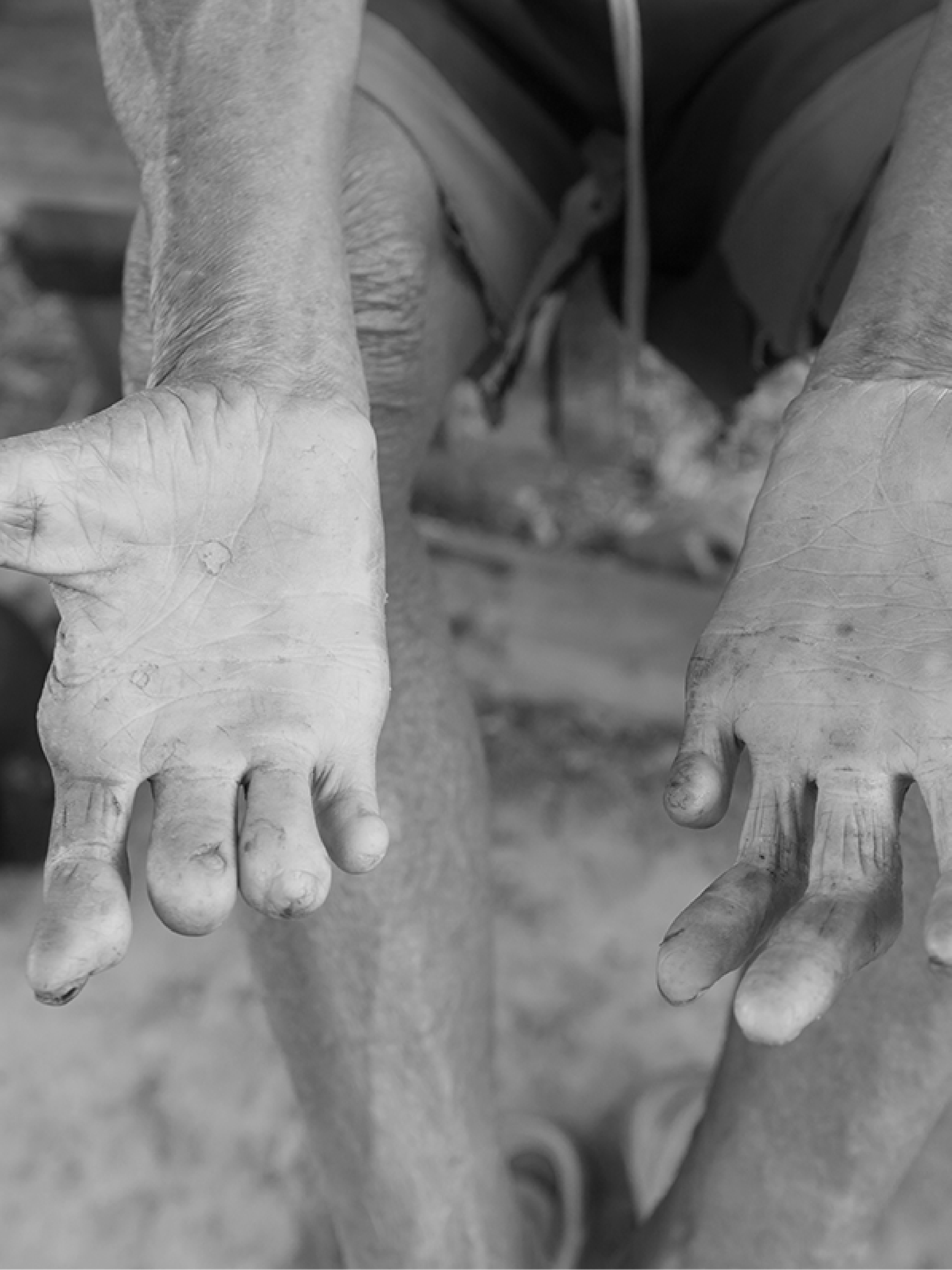 Leprosy: The Current Scenario