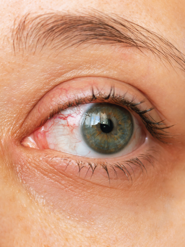 Dry Eye Workup - How to Apply DEWS 2?