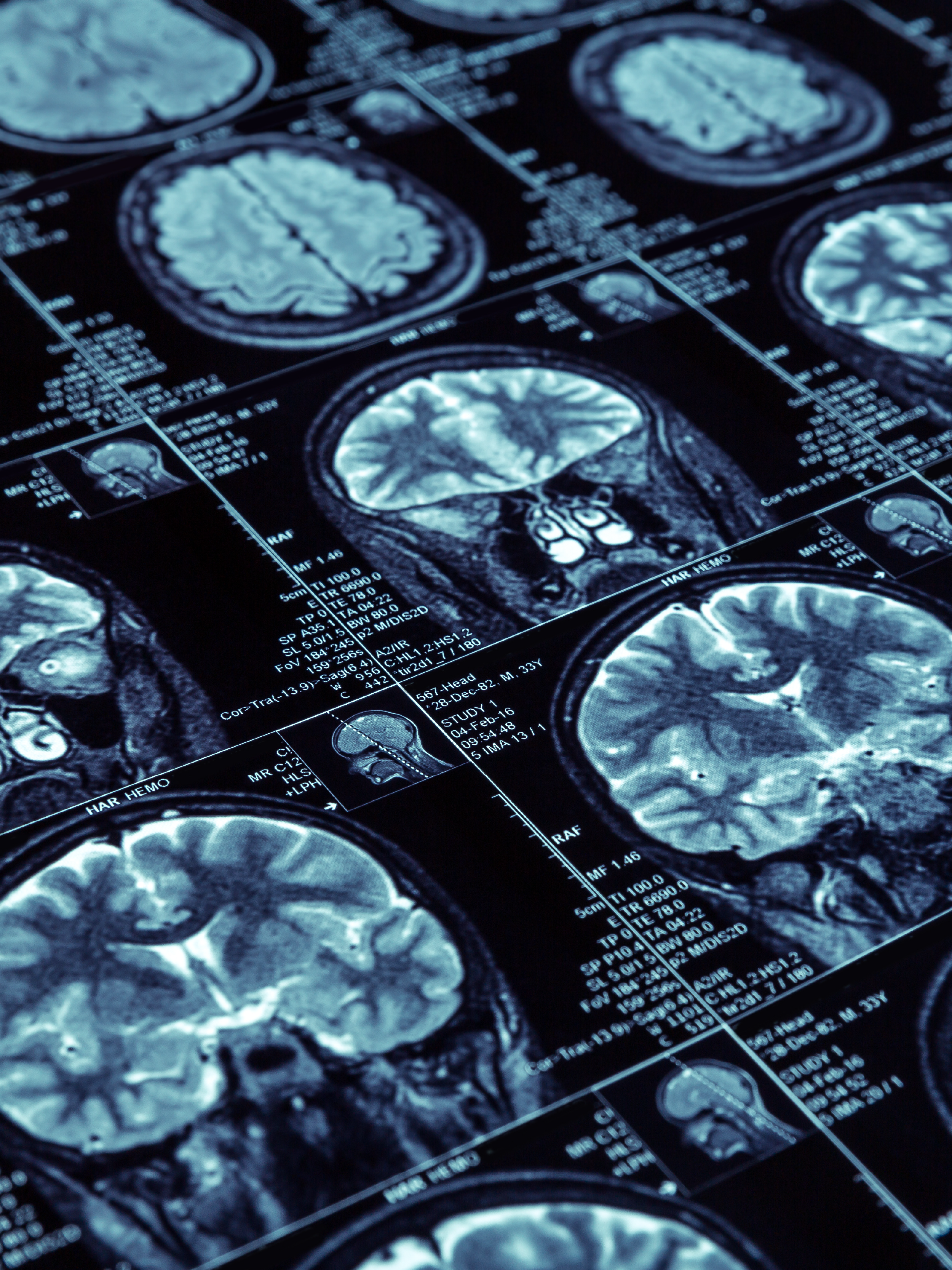Chronic Traumatic Encephalopathy: The Preventable Silent Killer