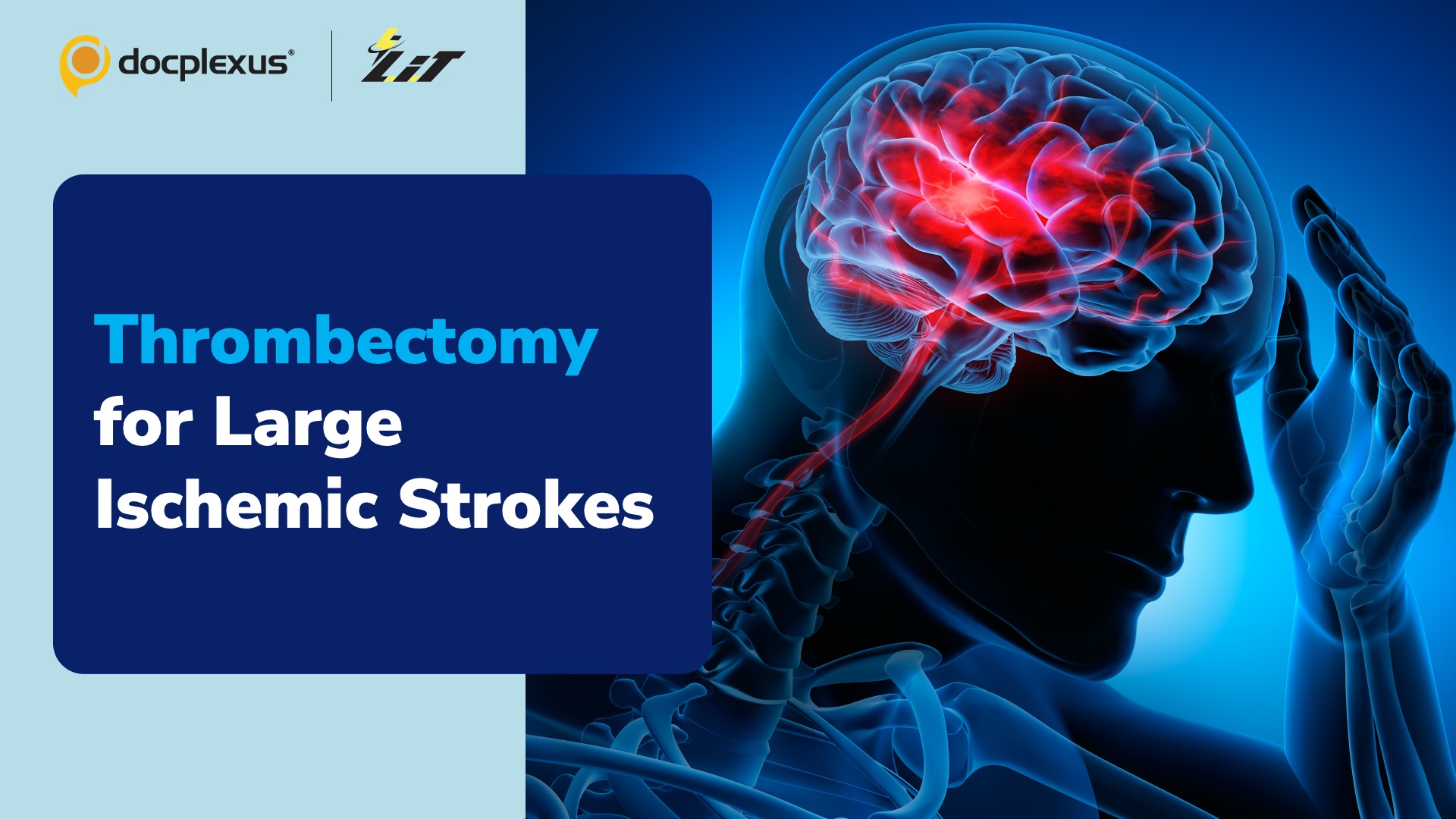 Can Thrombectomy be Used to Treat Large Ischemic Strokes?