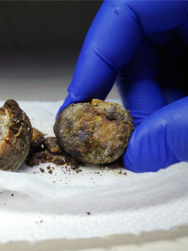 Laparoscopic Approach – When the Gallstones get Tough