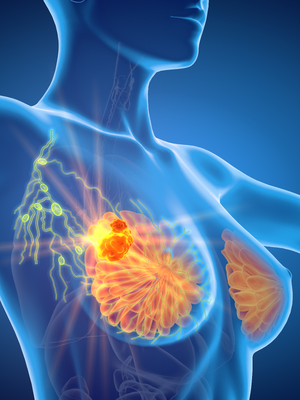 Role of Oncoplasty in Early Breast Cancers