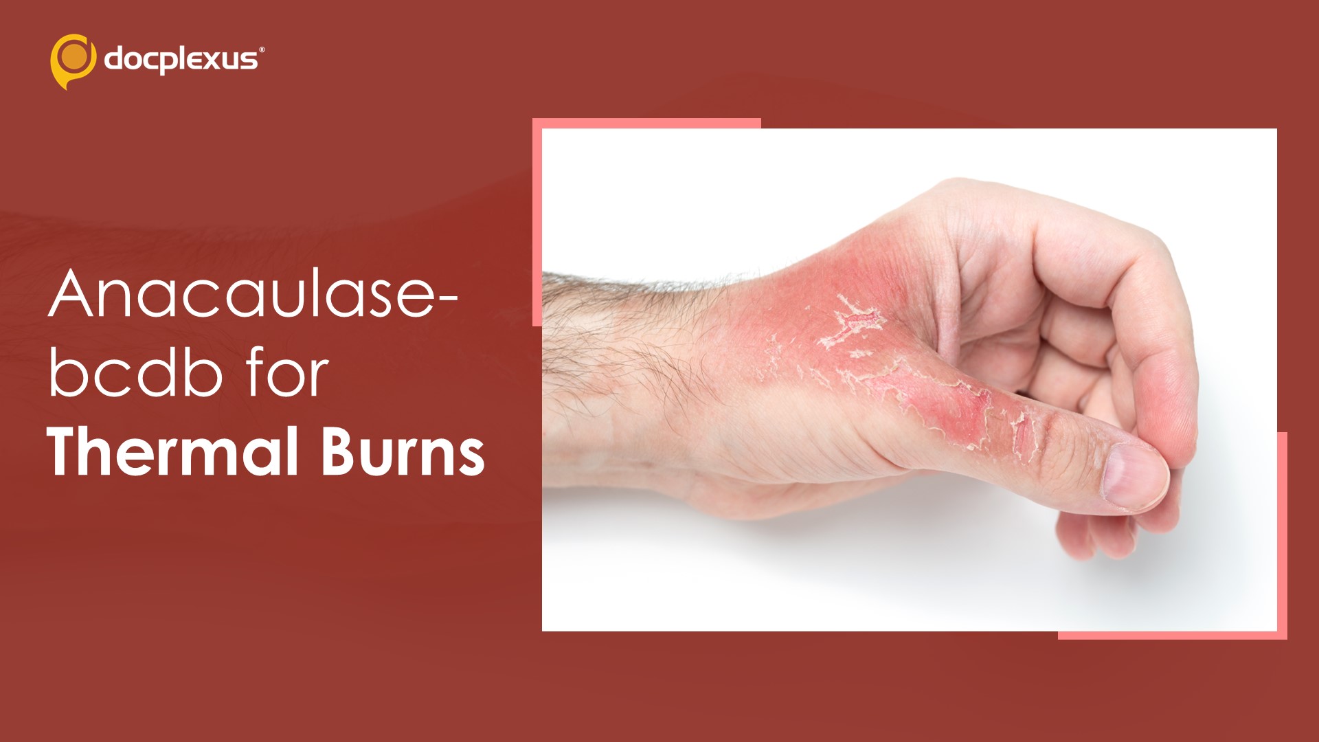 USFDA Approves Anacaulase-bcdb for Treating Severe Thermal Burns