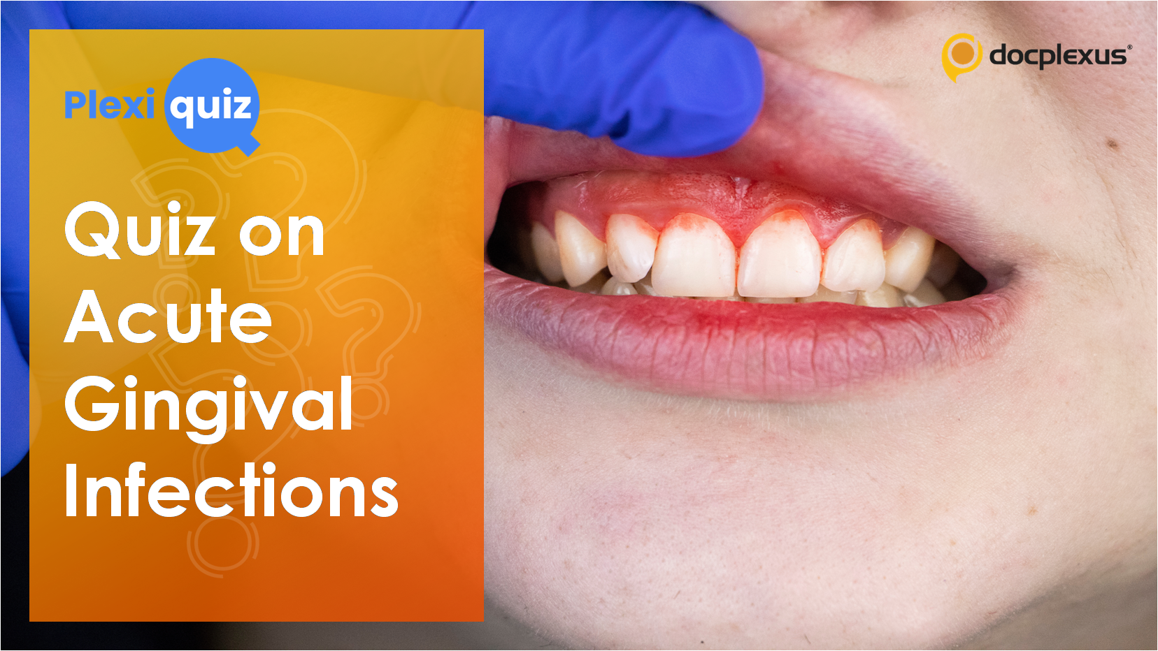 Acute Infections of Gingiva: How Well Do You Know Them?
