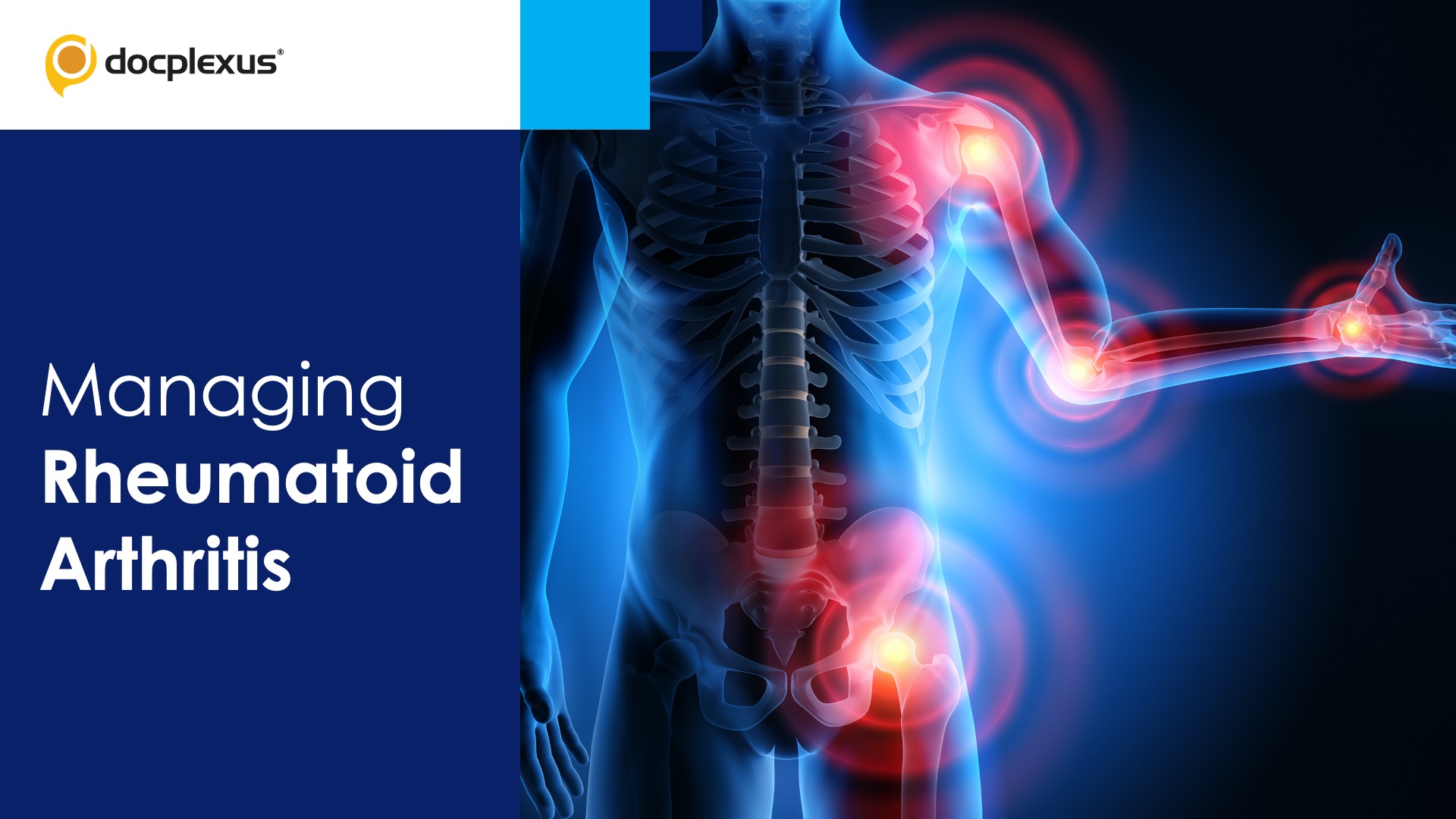 Managing Rheumatoid Arthritis