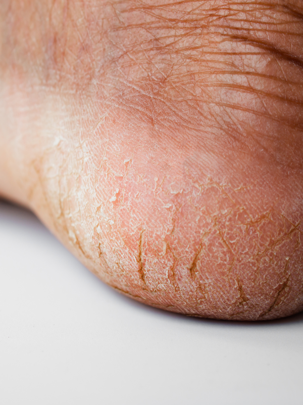 Diabetic Xerosis Management: A Journey Towards Better Life