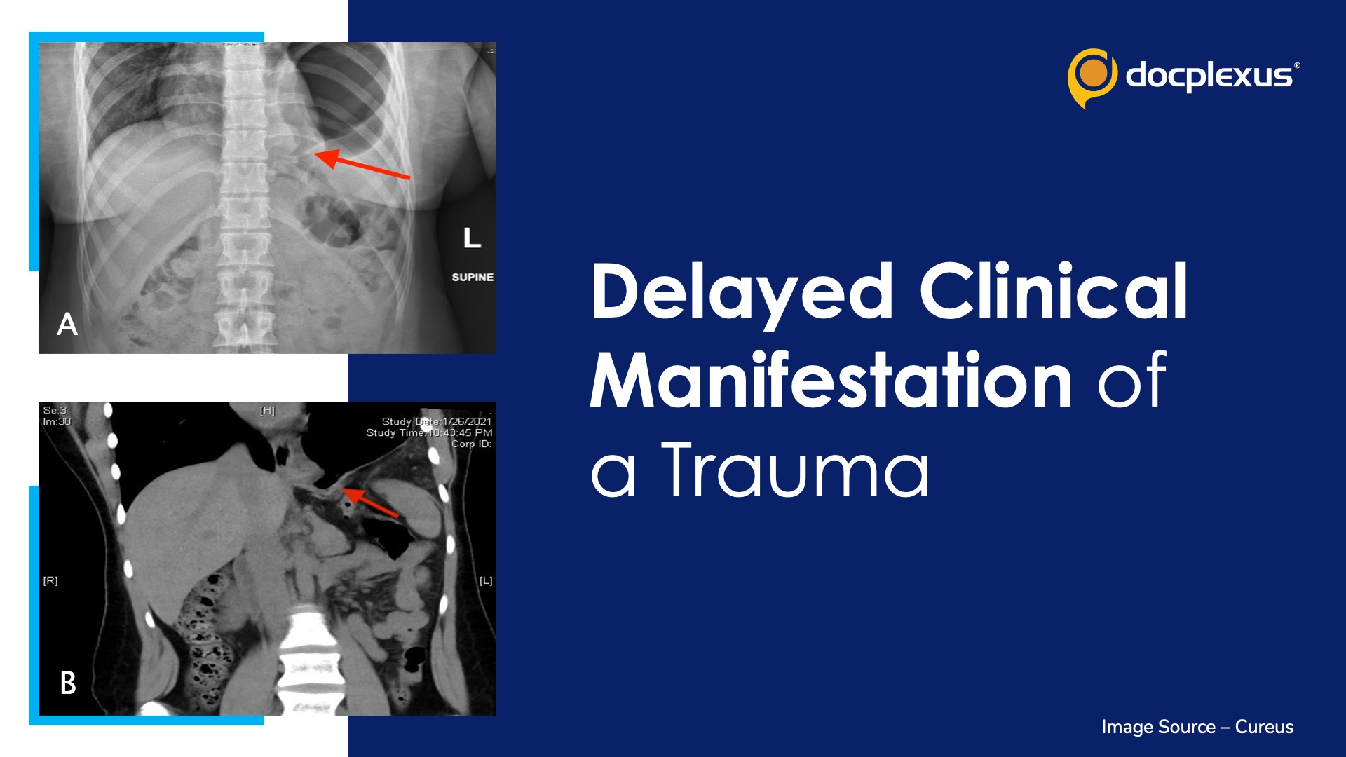 Identify this Delayed Clinical Manifestation of Trauma
