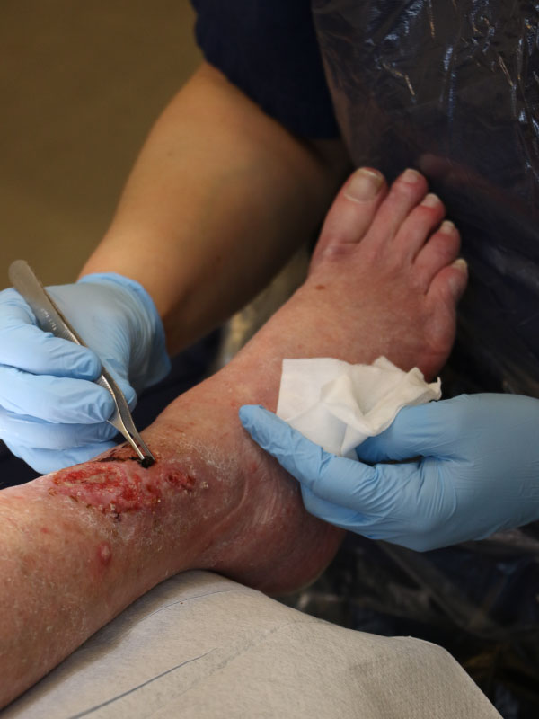 Venous Ulcers
