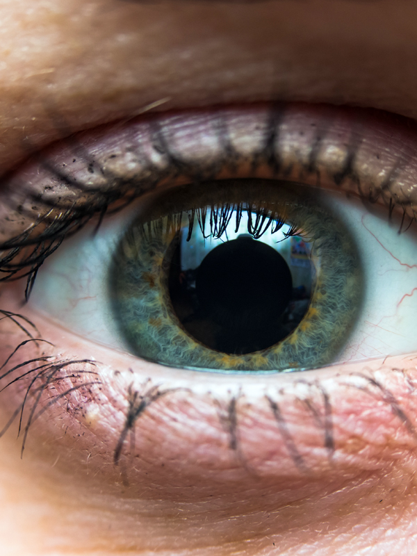 Dry Eye Syndrome — Causes, Symptoms, and Treatment