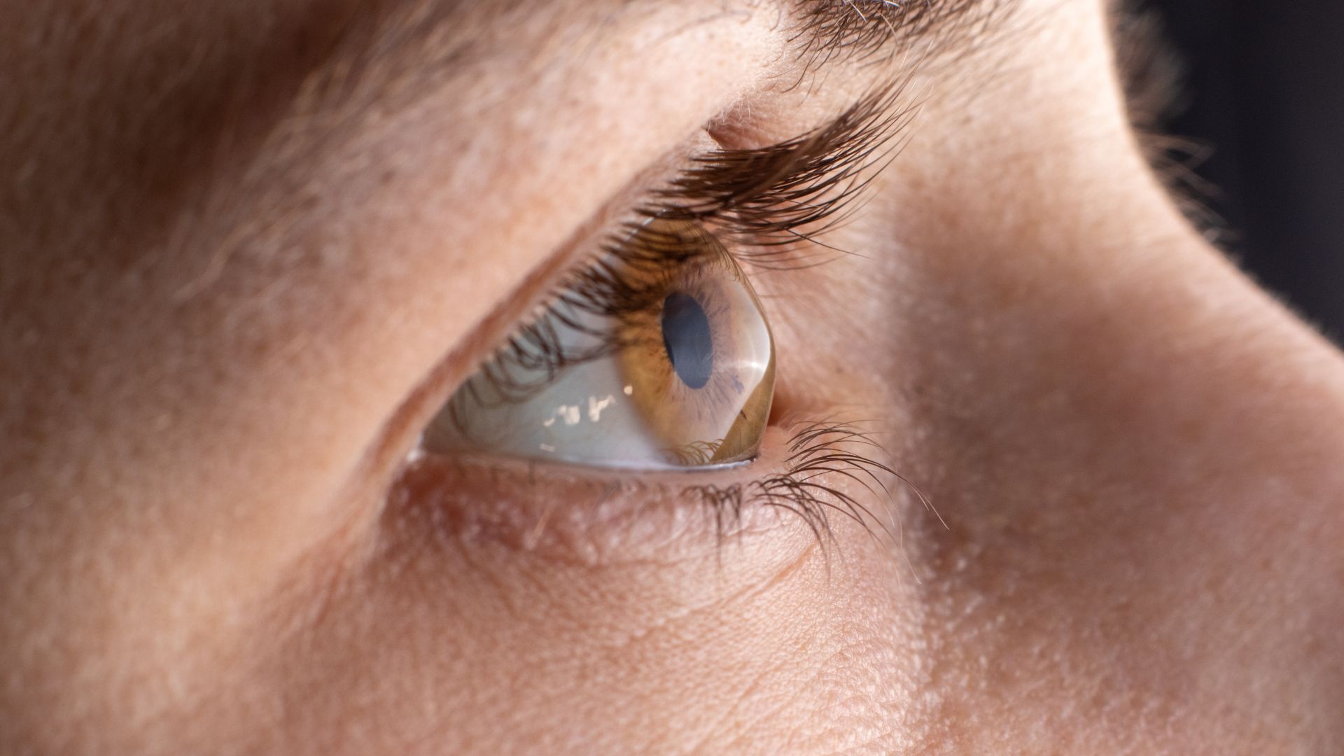 Contact Lens Assisted Corneal Cross Linking in Thin Ectatic Corneas – A Review