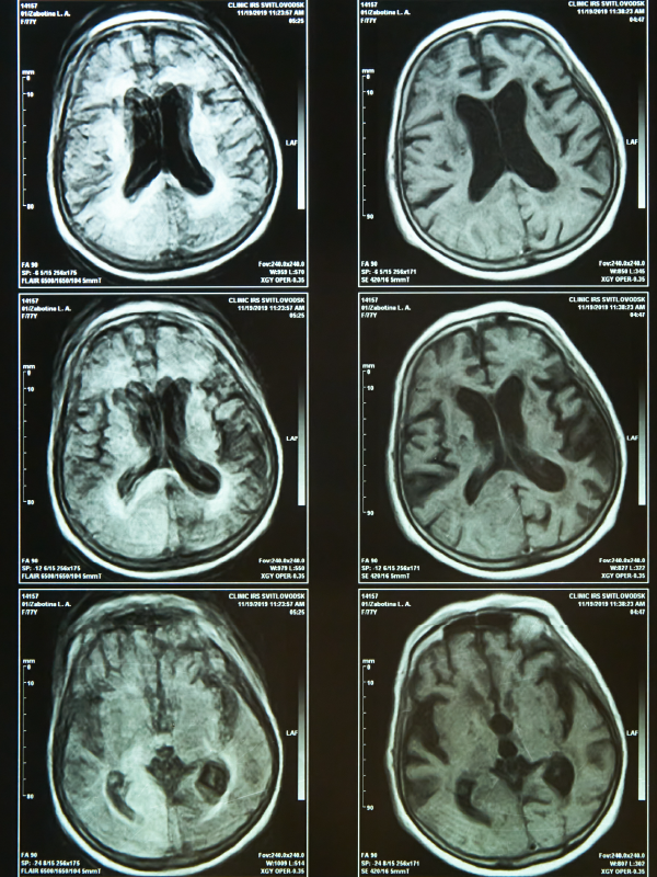 Treatment Strategies for Anterior Skull Base Malignancies