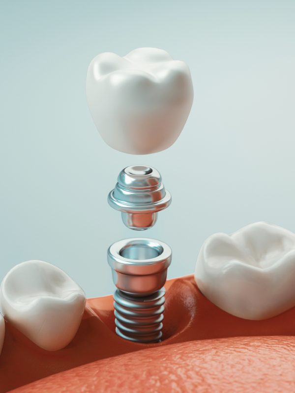 A to Z of Single Implant Prosthesis
