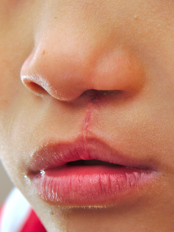 Overview of Cleft Surgeries