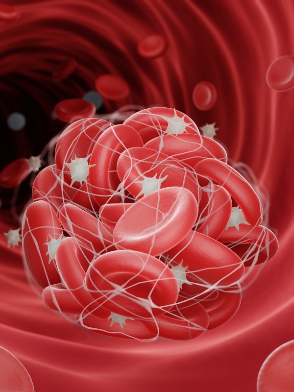Thrombocytopenia in Children