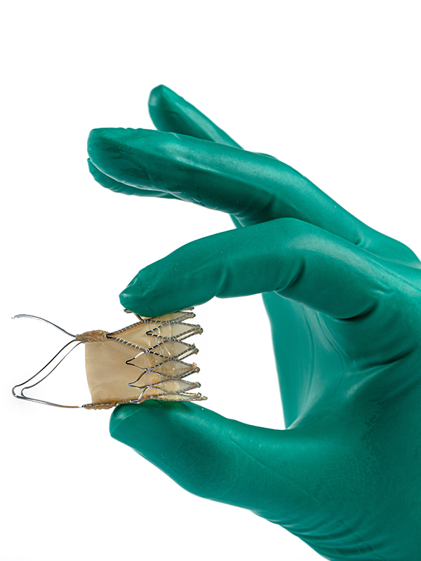 The Ozaki Neocuspidization of Aortic Valve: The Long-term Option for All Ages
