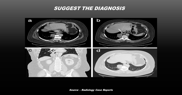 Case of a Man with an Unexplained Abdominal Pain