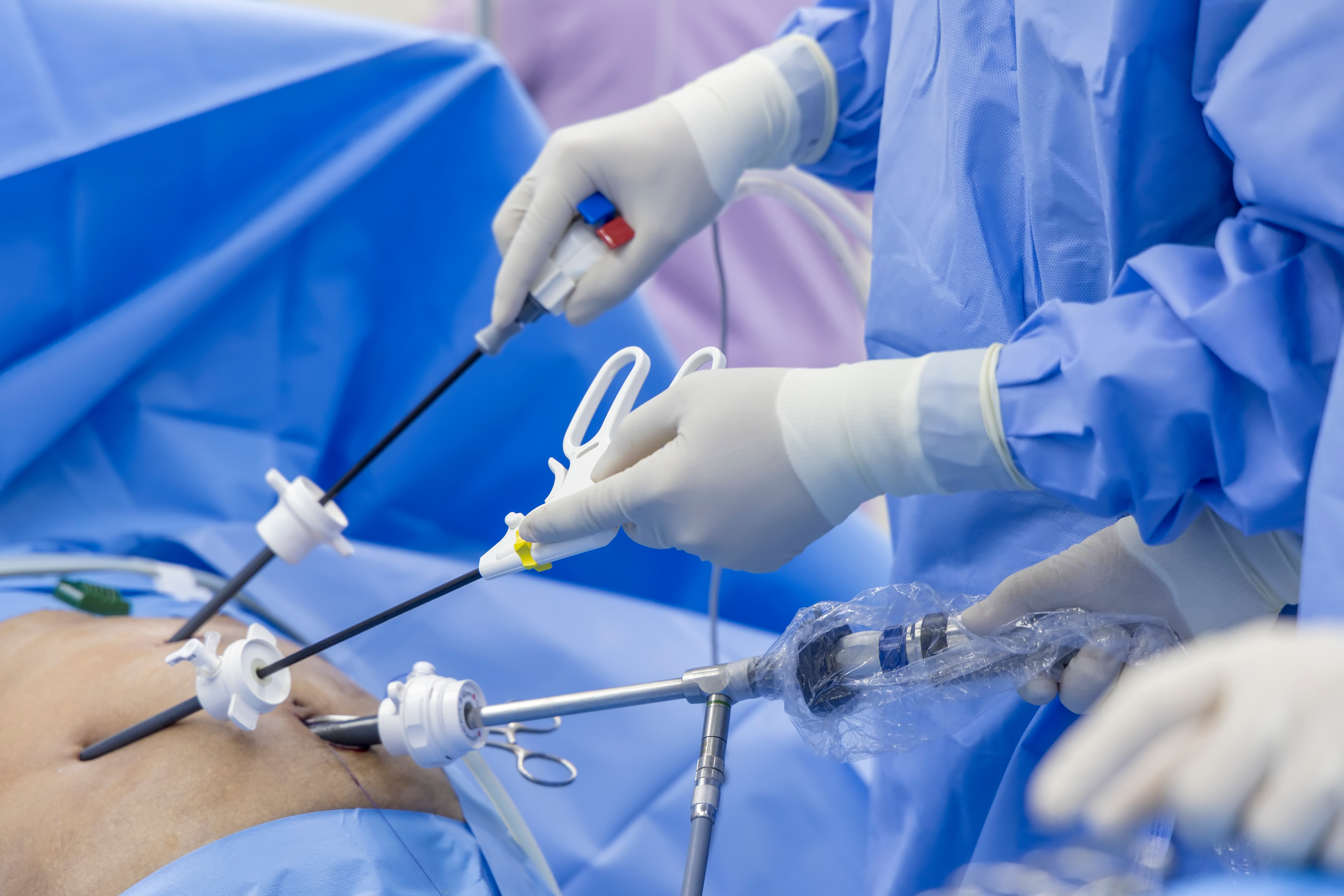 Perforated Appendix: Pneumoperitoneum & Secondary Peritonitis