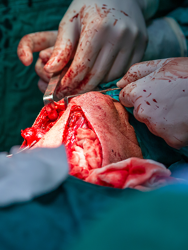 Different Pediatric Head and Neck Cancers – Our Experience