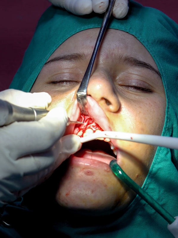 Apicectomy with Bone Grafts: What You Need to Know