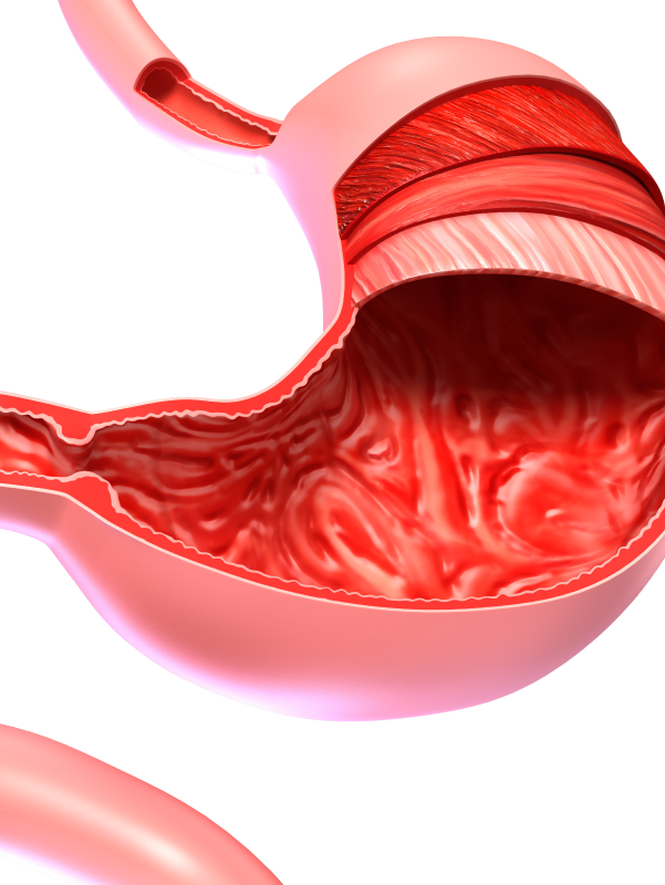 Revision Bariatric Surgery