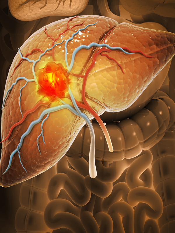 Liver Surgery for Malignant Disease – Current Perspectives