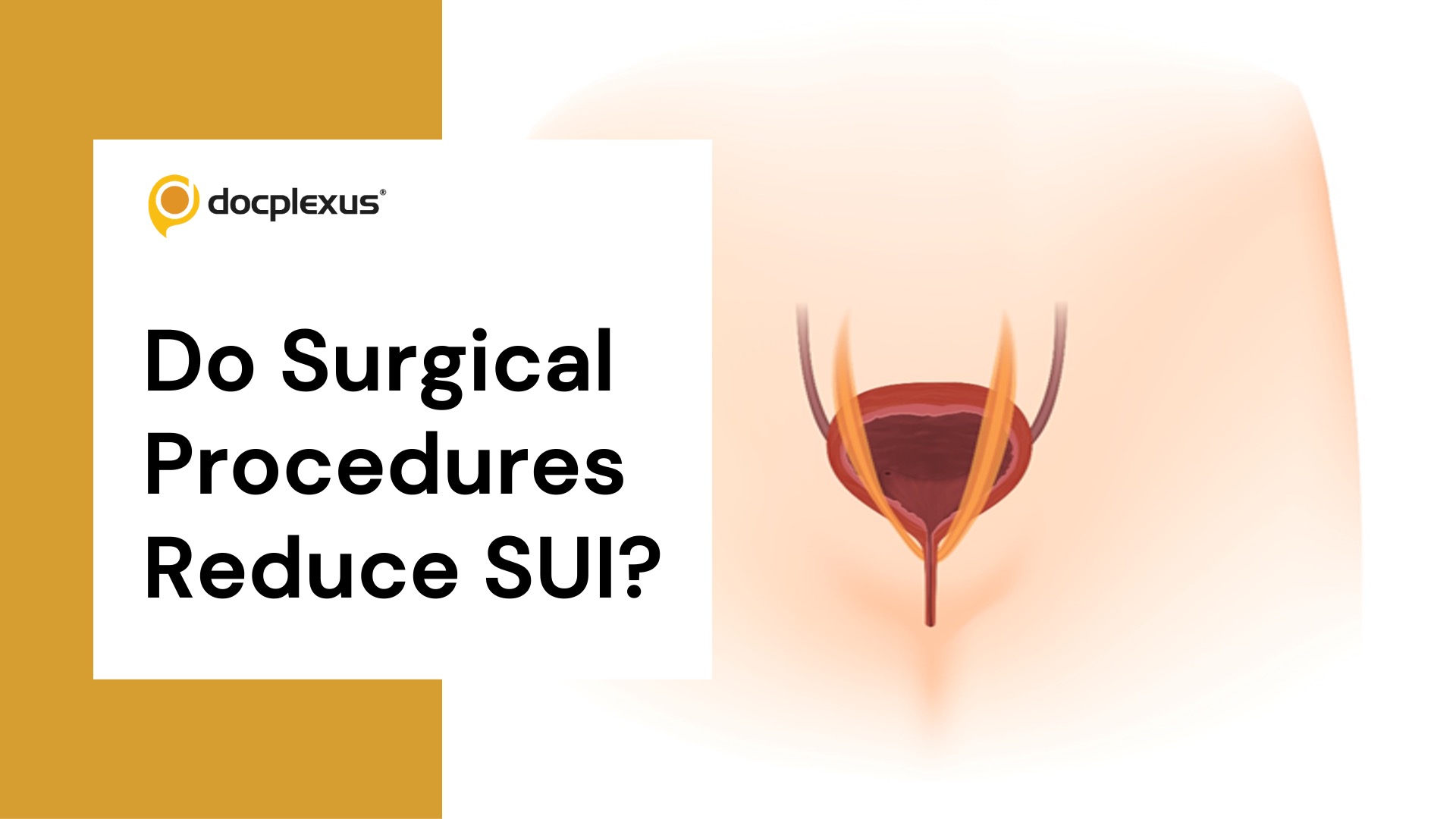 Surgical Procedures for Stress Urinary Incontinence in Women