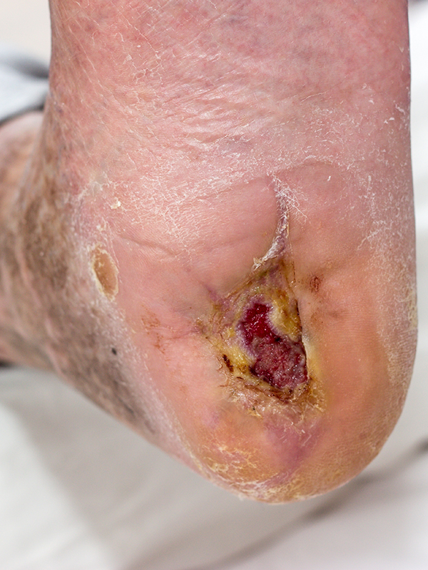 Stepping Ahead: Navigating the Challenges of Diabetic Foot Health
