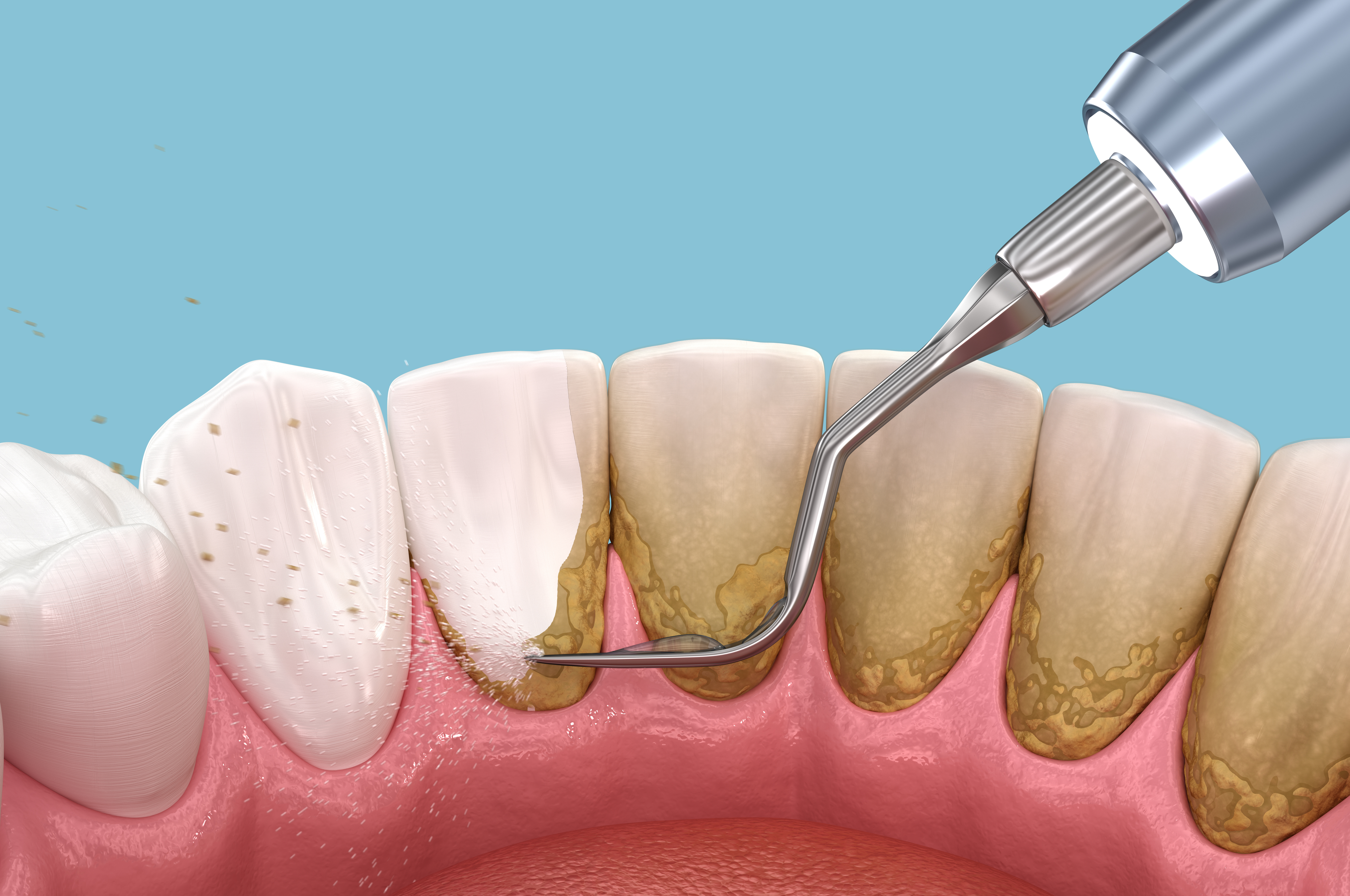 Surface Roughness on Dental Tissues by Abrasives