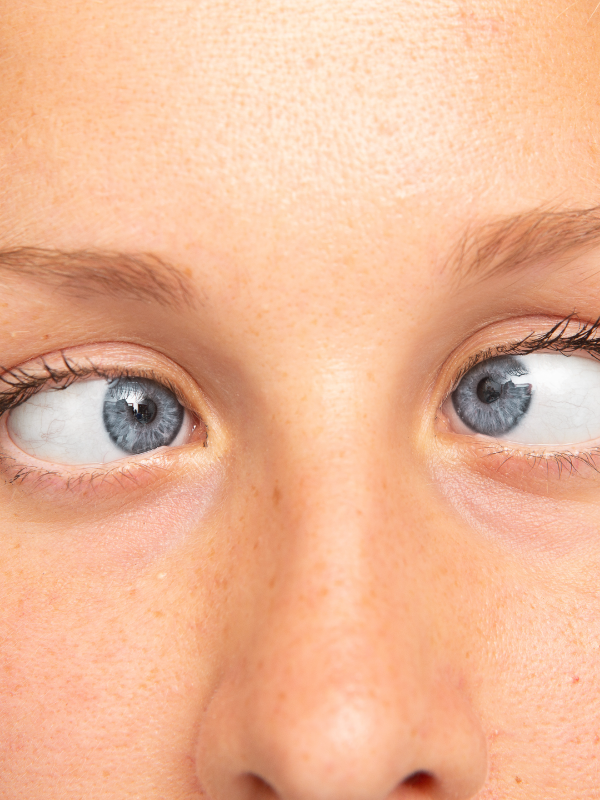 Strabismus: Evaluation and Management