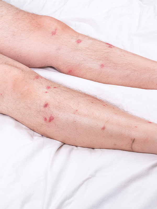 Compression Therapy in Venous Ulcers