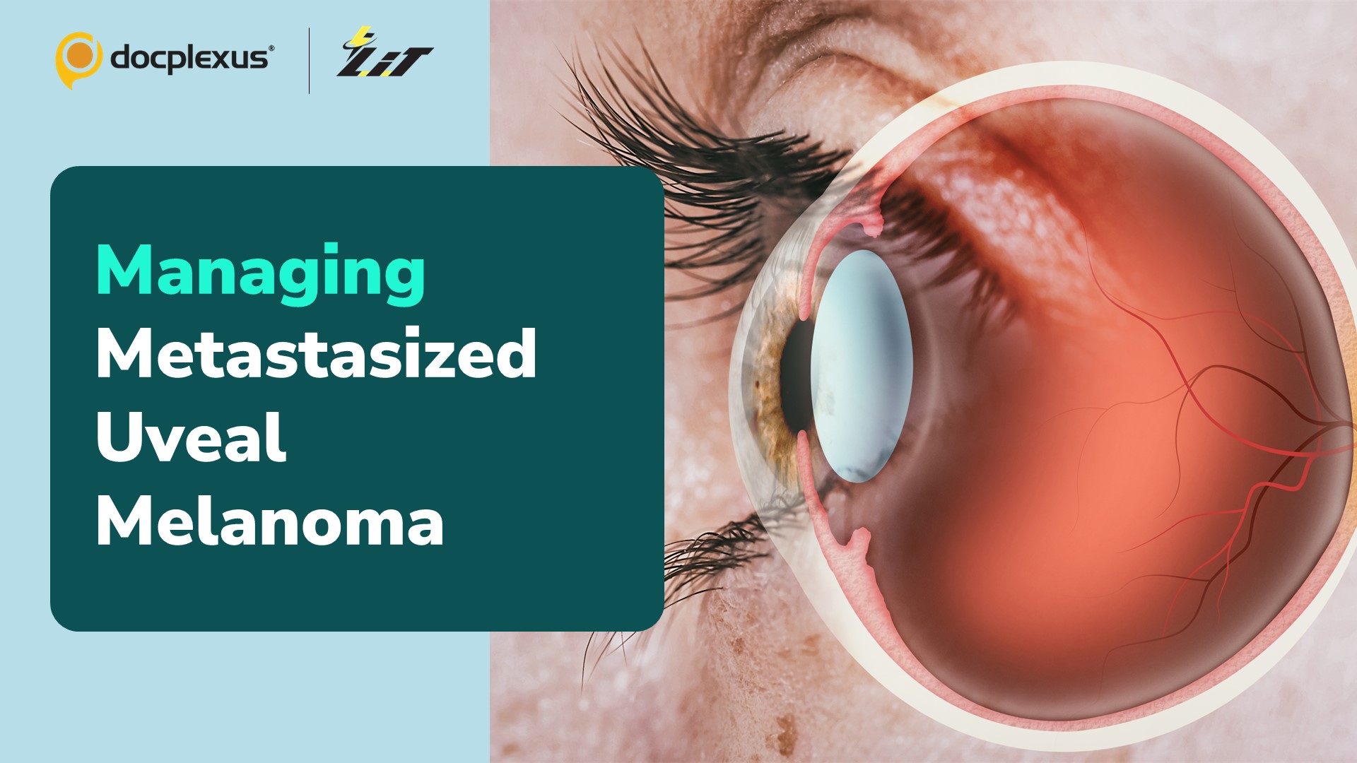 Novel Treatment Improves PFS & ORR in Uveal Melanoma with Liver Metastases