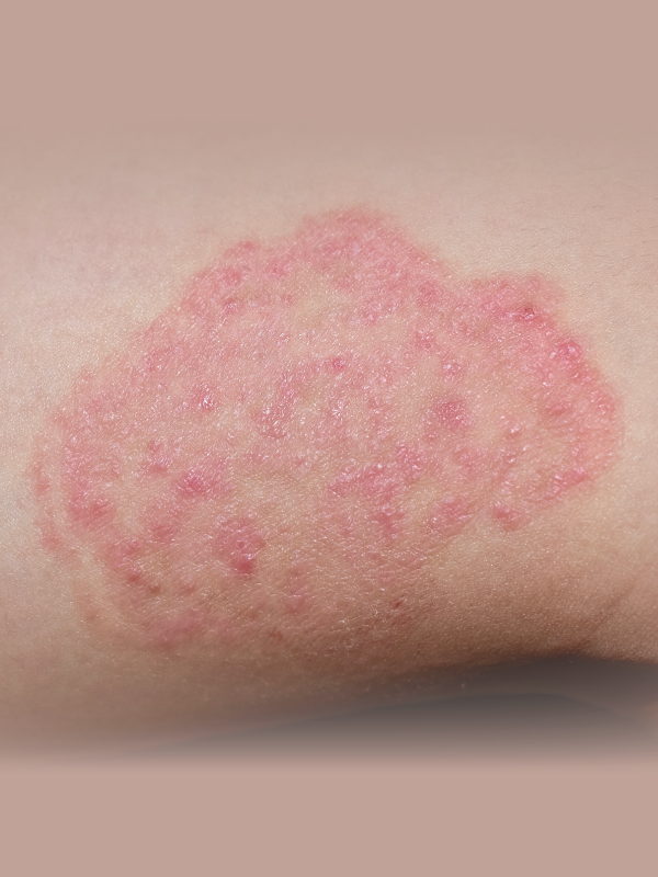 Management of Tinea Infections