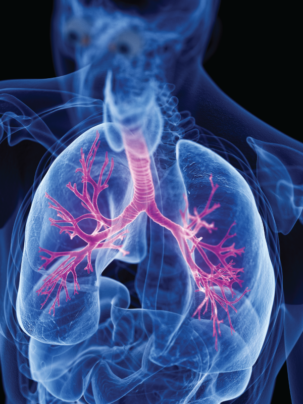Biological Therapy in Severe Asthma